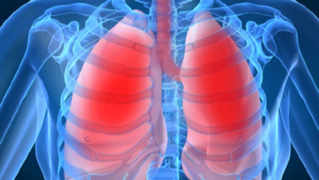 Láz nélkül támad a tüdőgyulladás